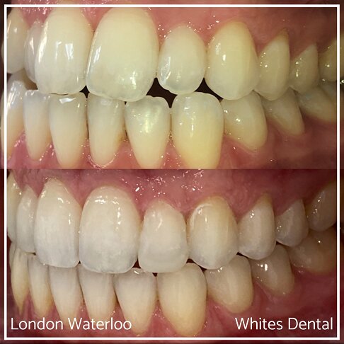 Invisalign Braces Before And After Orthodontist in London 17 Overcrowding | Whites Dental