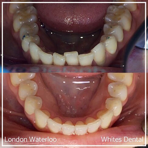 Invisalign Braces Before And After Orthodontist in London 18 Overcrowding | Whites Dental