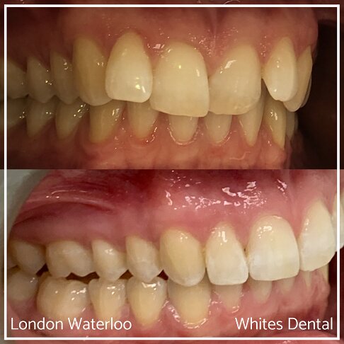 Invisalign Braces Before And After Orthodontist in London 19 Overcrowding | Whites Dental
