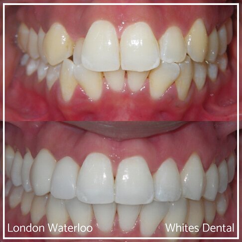 Invisalign Braces Before And After Orthodontist in London 2 Worst Cases | Whites Dental