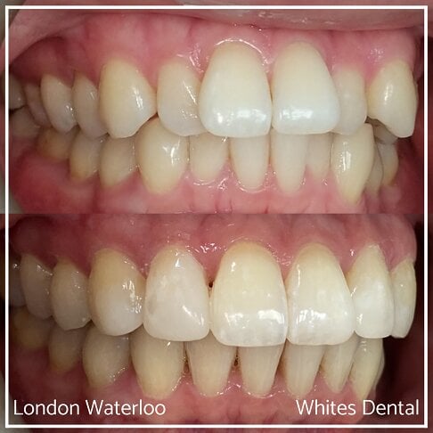 Invisalign Braces Before And After Orthodontist in London 21 Overcrowding | Whites Dental