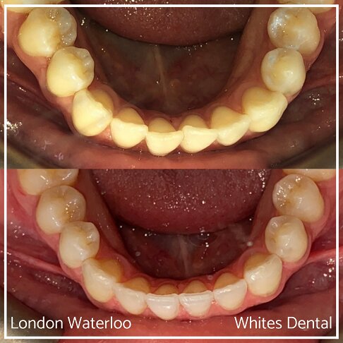 Invisalign Braces Before And After Orthodontist in London 22 Overcrowding | Whites Dental