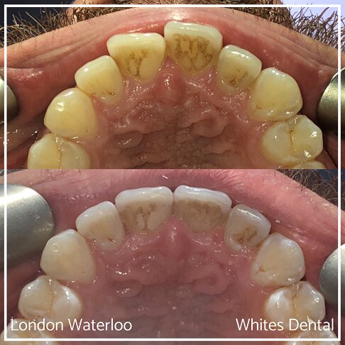 Invisalign Braces Before And After Orthodontist in London 23 Overcrowding | Whites Dental