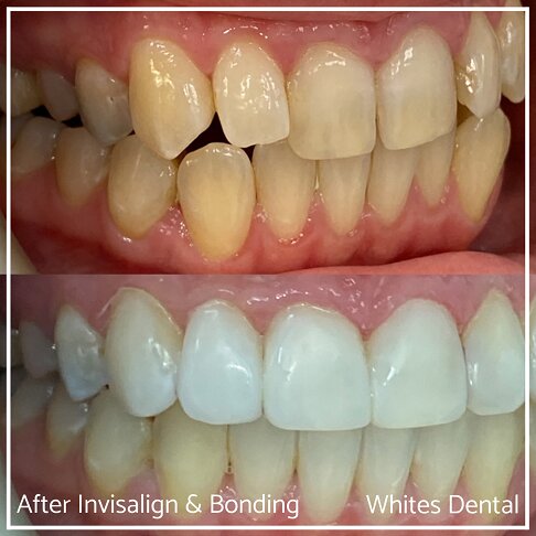Invisalign Braces Before And After Orthodontist in London 24 Overcrowding | Whites Dental