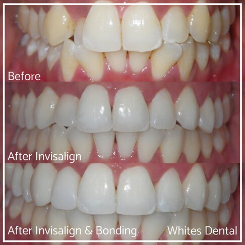 Invisalign Braces Before And After Orthodontist in London 25 Overcrowding | Whites Dental