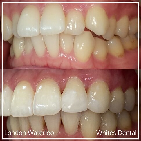 Invisalign Braces Before And After Orthodontist in London 26 Overcrowding | Whites Dental