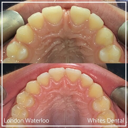 Invisalign Braces Before And After Orthodontist in London 3 Gap | Whites Dental