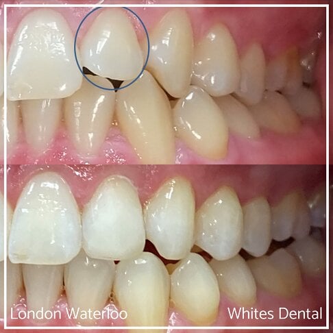 Photo showing displaced teeth due to overcrowding and the Invisalign result achieved