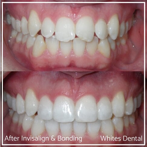 Invisalign Braces Before And After Orthodontist in London 3 Worst Cases | Whites Dental