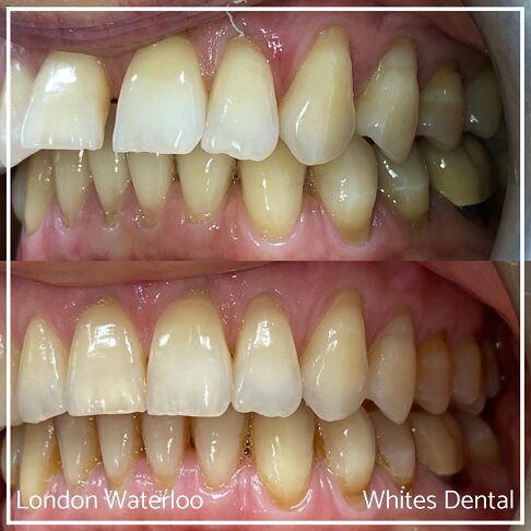Invisalign Braces Before And After Orthodontist in London 4 Gap | Whites Dental
