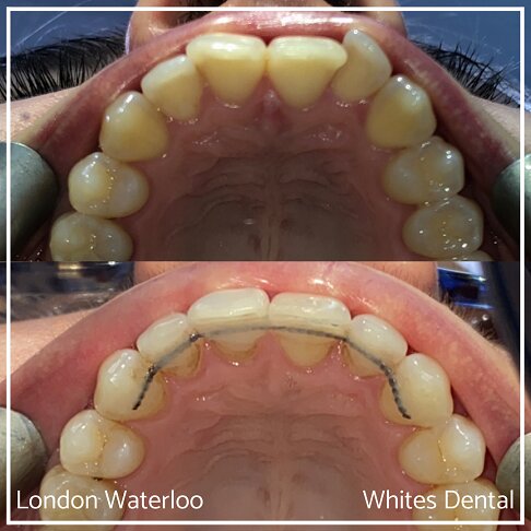 Invisalign Braces Before And After Orthodontist in London 4 Overbite Underbite | Whites Dental