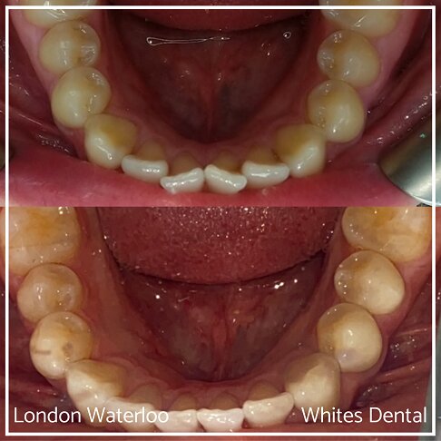Invisalign Braces Before And After Orthodontist in London 4 Overcrowding | Whites Dental