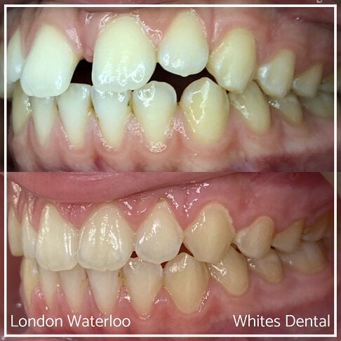 Invisalign Braces Before And After Orthodontist in London 5 Gap | Whites Dental