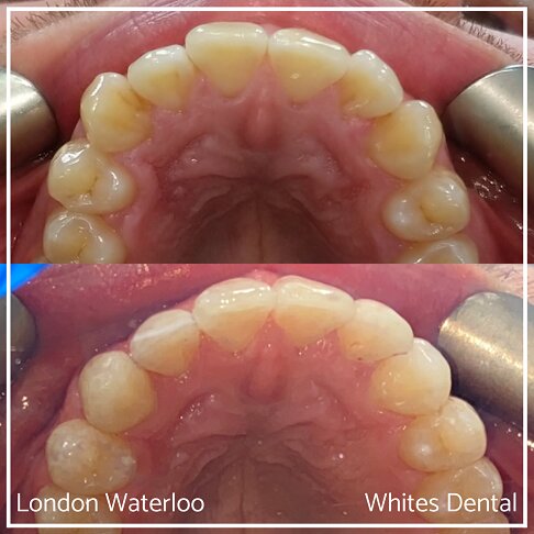 Invisalign Braces Before And After Orthodontist in London 5 Overcrowding | Whites Dental