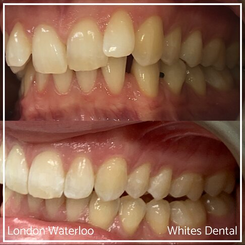 Invisalign Braces Before And After Orthodontist in London 5 Worst Cases | Whites Dental