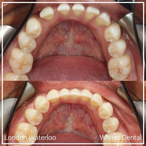 Successful Invisalign Teeth Gap Before and After Results in London Waterloo and Marble Arch - Case Study 6