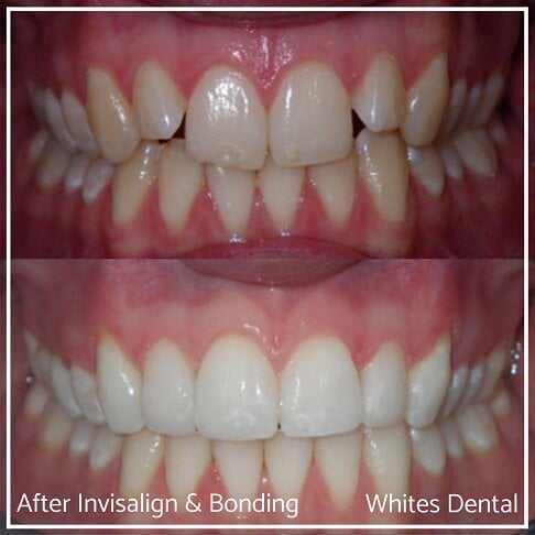 Invisalign Braces Before And After Orthodontist in London 6 Overbite Underbite | Whites Dental