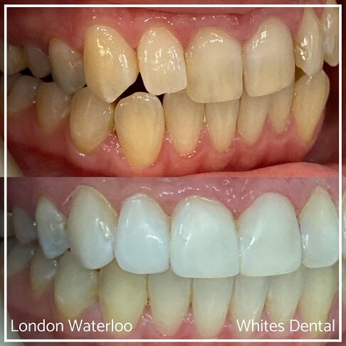 Invisalign Braces Before And After Orthodontist in London 6 Overcrowding | Whites Dental