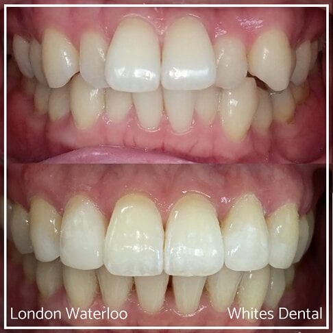 Invisalign Braces Before And After Orthodontist in London 6 Worst Cases | Whites Dental