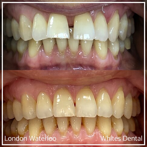 Invisalign Braces Before And After Orthodontist in London 7 Gap | Whites Dental
