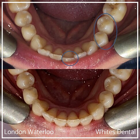 Invisalign Braces Before And After Orthodontist in London 7 Overcrowding | Whites Dental