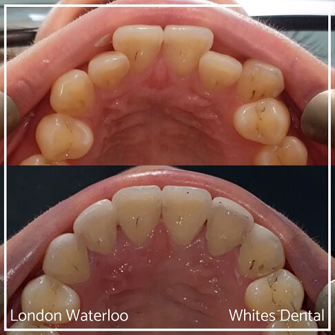 Invisalign Braces Before And After Orthodontist in London 8 Worst Cases | Whites Dental