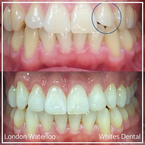 Invisalign Braces Before And After Orthodontist in London 9 Overcrowding | Whites Dental