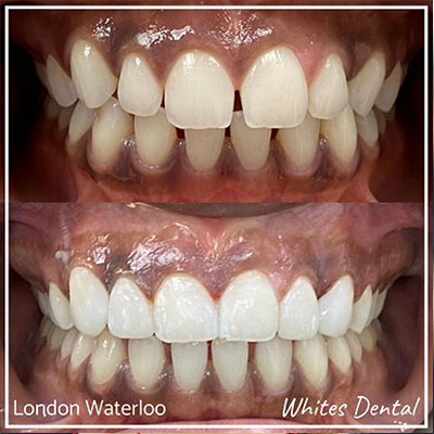 Invisalign For Gaps Between Teeth | £1,175 Off Invisalign Invisalign in London | Whites Dental