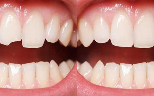 do dentist recommend composite bonding | Whites Dental
