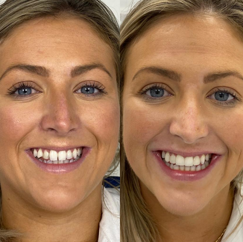 Composite Bonding Before And After London | Whites Dental