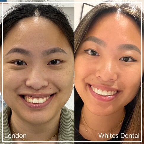 Invisalign Braces Before And After in London | Whites Dental