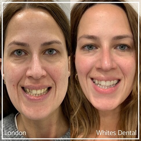 Invisalign Braces Before And After in London | Whites Dental