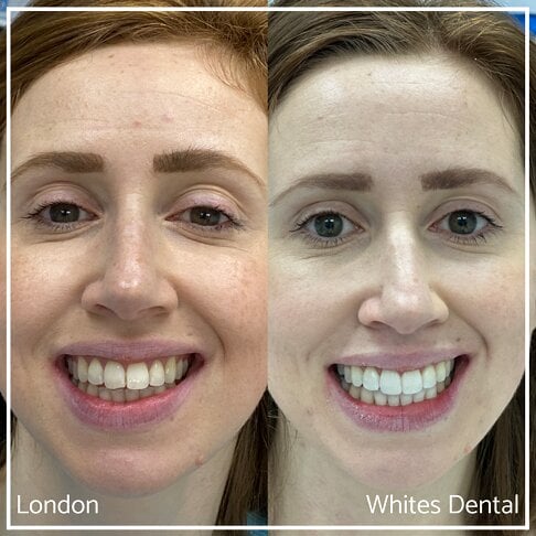 Before treatment and post treatment photo - showing the effective Invisalign treatment