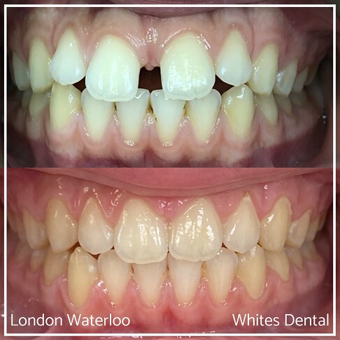 Invisalign Gap Teeth in London UK | Whites Dental