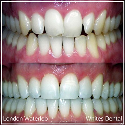 How do I find the best Invisalign dentist in London UK | Whites Dental