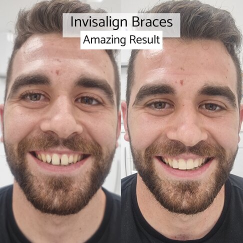 invisalign real results | Whites Dental