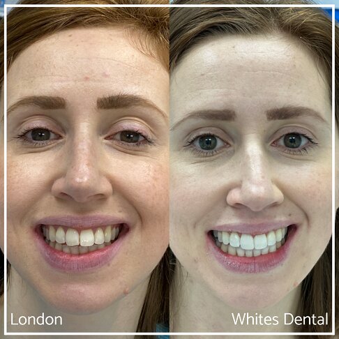 invisalign before and after gap | Whites Dental