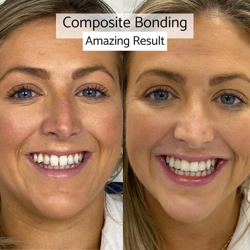 is composite bonding worth it? | Whites Dental
