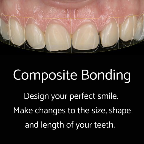 what is composite bonding in uk | Whites Dental
