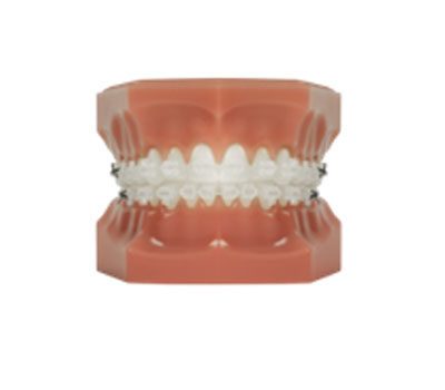 what is an orthodontist photograph of fast braces | Whites Dental