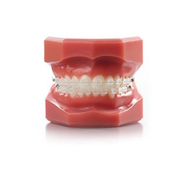 orthodontist pricing model showing ceramic braces | Whites Dental