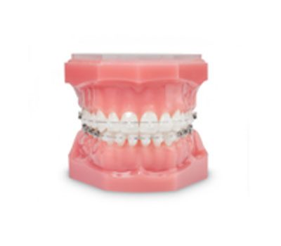 orthodontist pricing photo of damon braces | Whites Dental