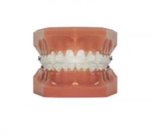 orthodontist pricing photo of fast braces | Whites Dental