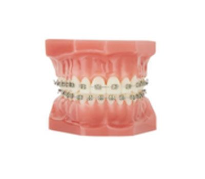 orthodontist pricing photo and model of metal braces | Whites Dental
