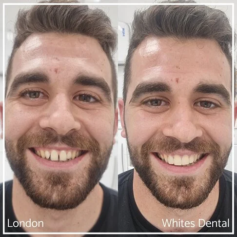Composite-Bonding-Before-And-After-Cosmetic-Dentist-In-London-2