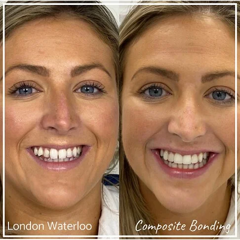 Composite Bonding Before and After Homepage 1 | Whites Dental