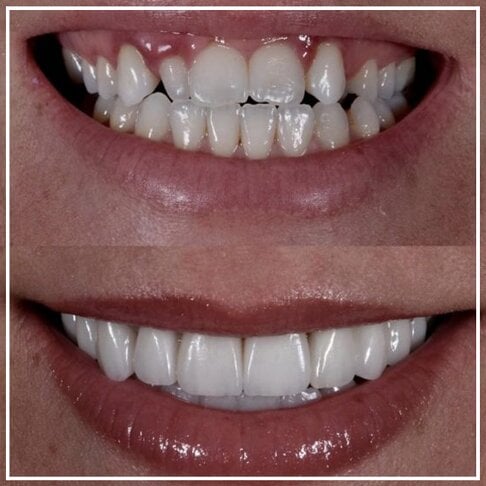 Porcelain Veneers London Crooked teeth