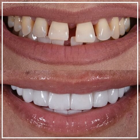 Porcelain Veneers London Gaps In Teeth