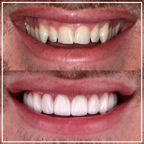 Porcelain Veneers London Uneven Teeth