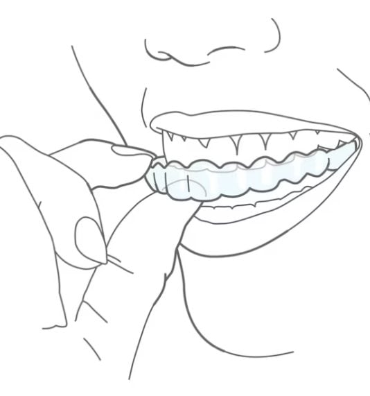 Invisalign in London